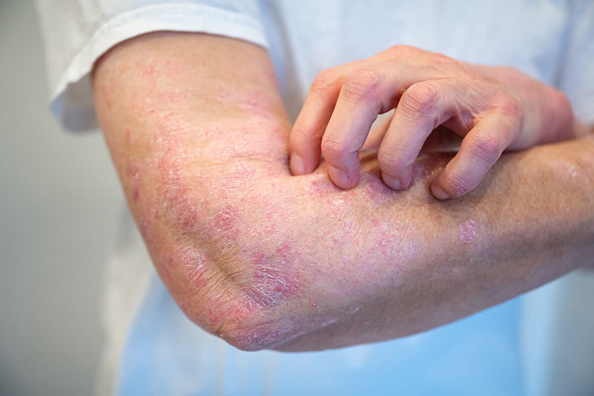 Palenie papierosów a łuszczyca – jaki jest związek