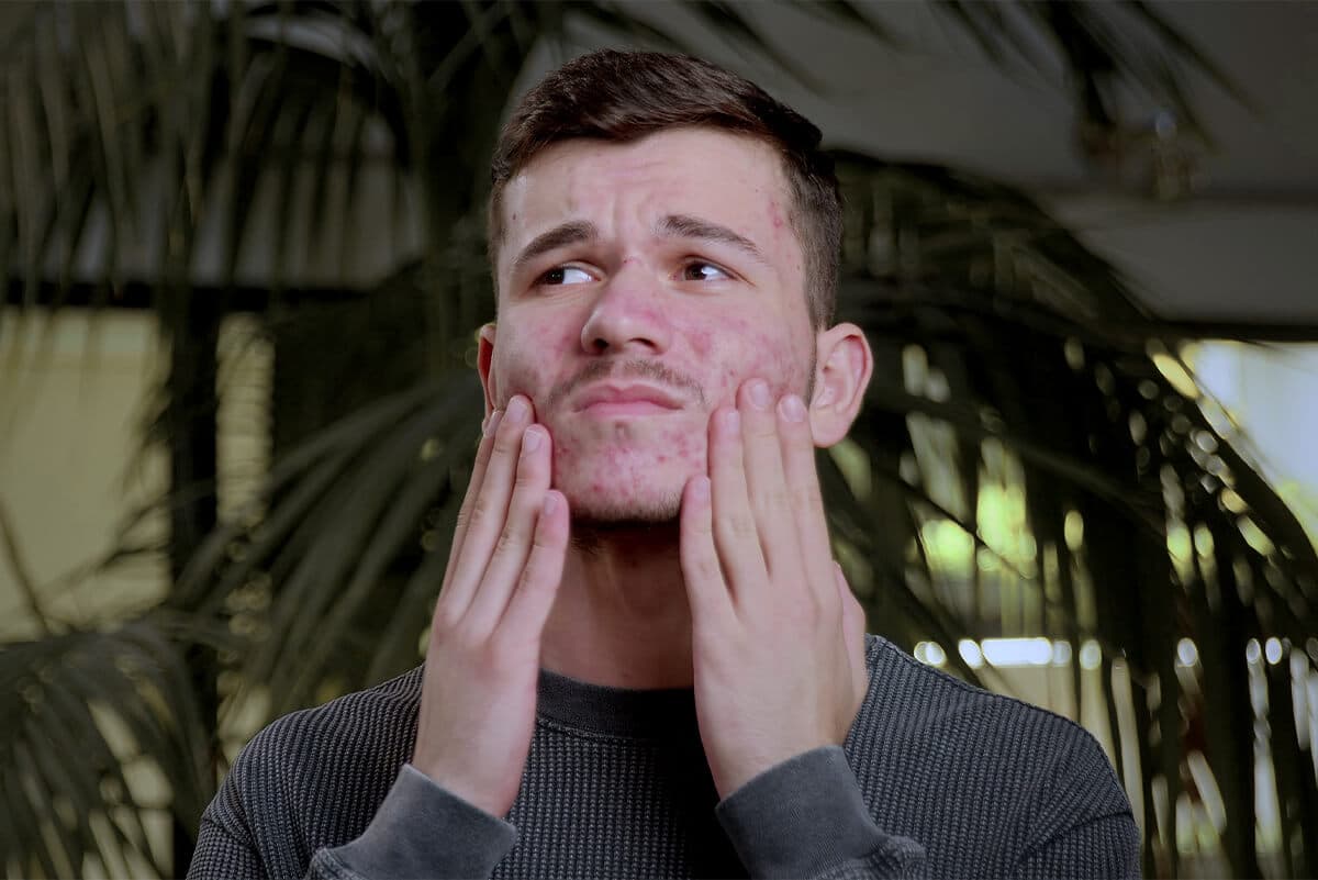 Związek palenia tytoniu i rozwoju trądziku