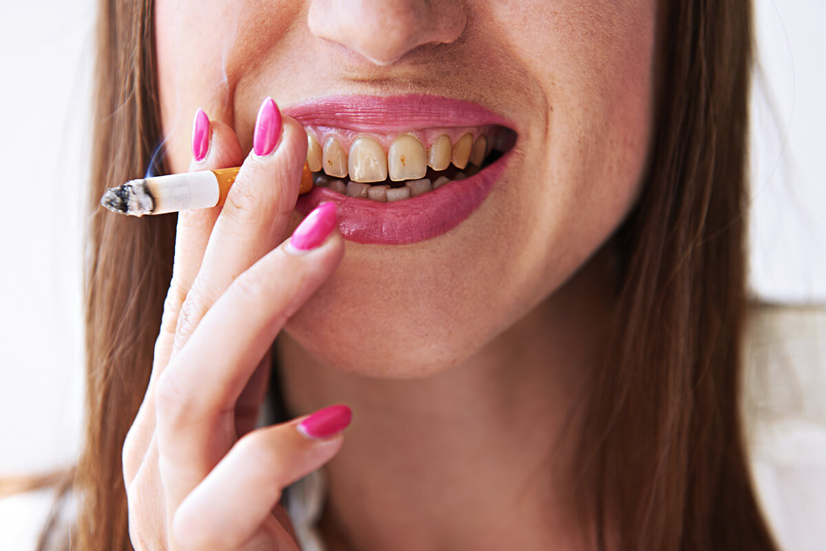 Zęby palacza – czy palenie ma wpływ na stan zębów?